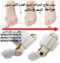 علاج بروز إبهام القدم بدون جراحة جهاز تقويم اصبع القدم الكبير .